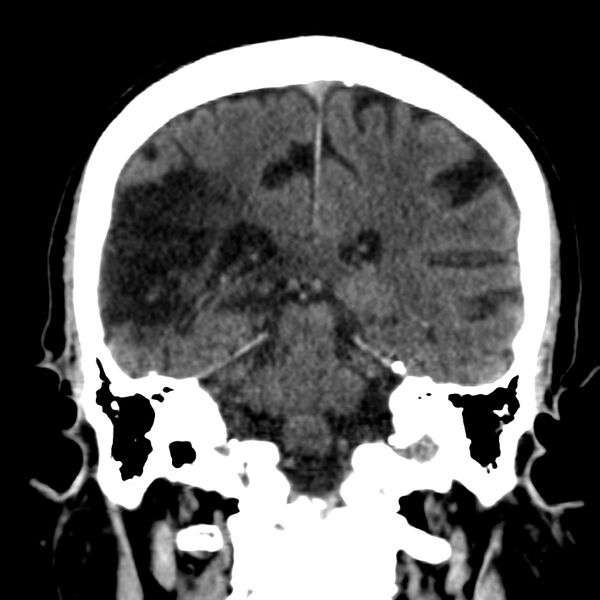 File:Brain Pantopaque remnants (Radiopaedia 78403-91048 Coronal non-contrast 44).jpg