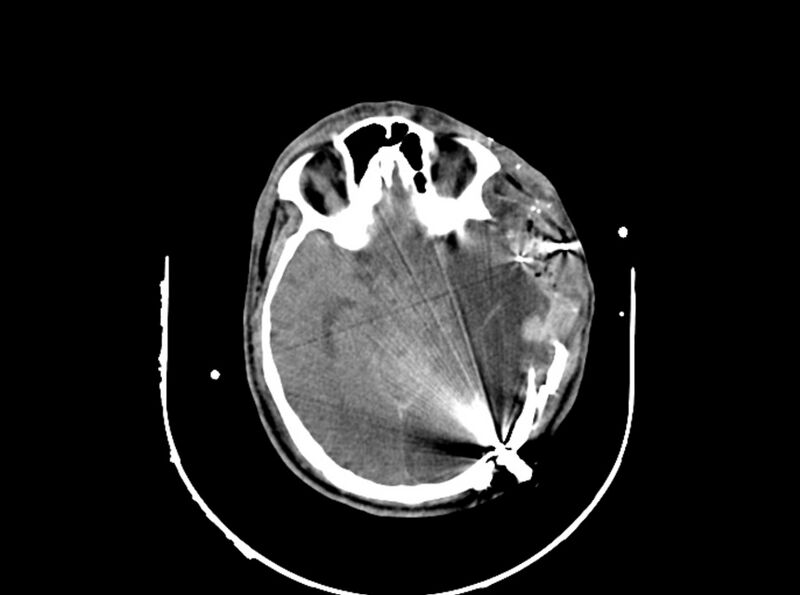 File:Brain injury by firearm projectile (Radiopaedia 82068-96087 B 91).jpg