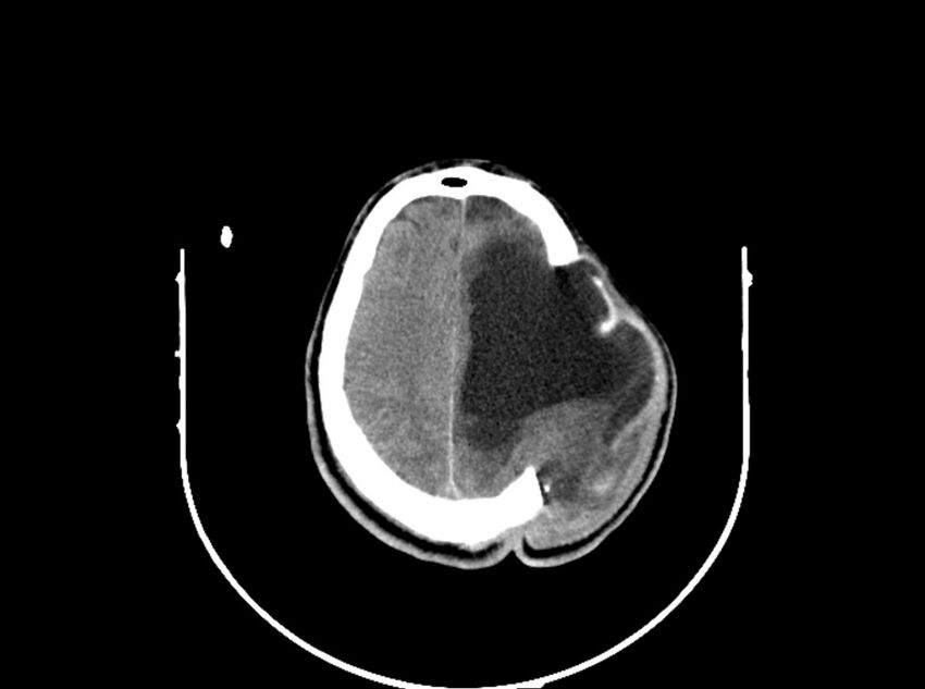 Brain injury by firearm projectile (Radiopaedia 82068-96088 A 167).jpg