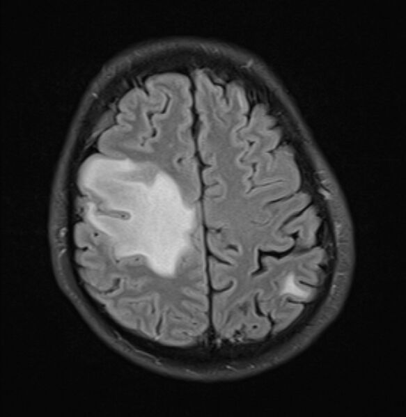 File:Brain metastases - lung cancer primary (Radiopaedia 75060-86115 Axial FLAIR 19).jpg