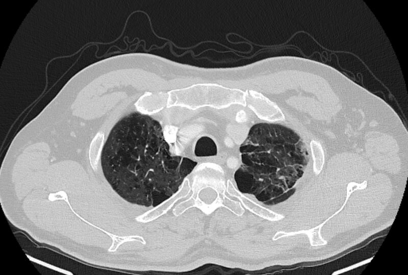 File:Brain metastases - lung cancer primary (Radiopaedia 75060-86116 Axial lung window 7).jpg