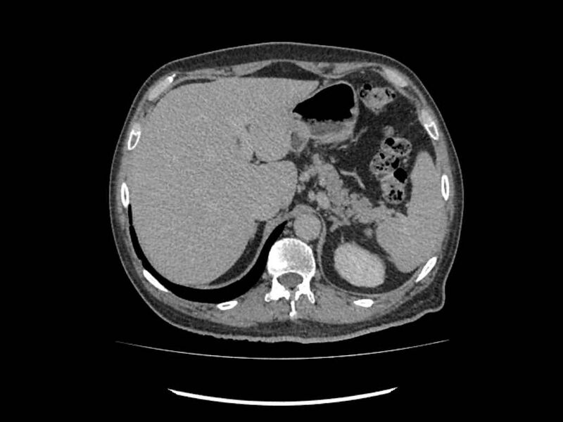 File:Brain metastases from renal cell carcinoma (Radiopaedia 42222-45328 Axial C+ delayed 9).jpg