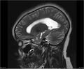Brainstem glioma (Radiopaedia 21819-21775 Sagittal T2 19).jpg