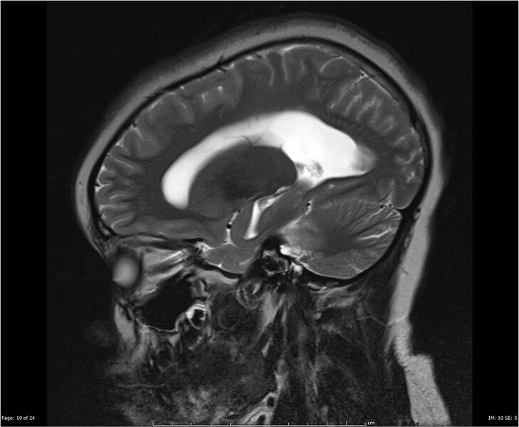 File:Brainstem glioma (Radiopaedia 21819-21775 Sagittal T2 19).jpg