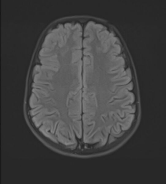 File:Brainstem glioma (Radiopaedia 70548-80674 Axial FLAIR 18).jpg