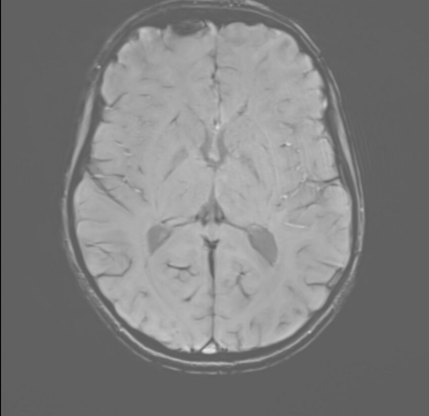Brainstem glioma (Radiopaedia 70548-80674 Axial SWI 33).jpg