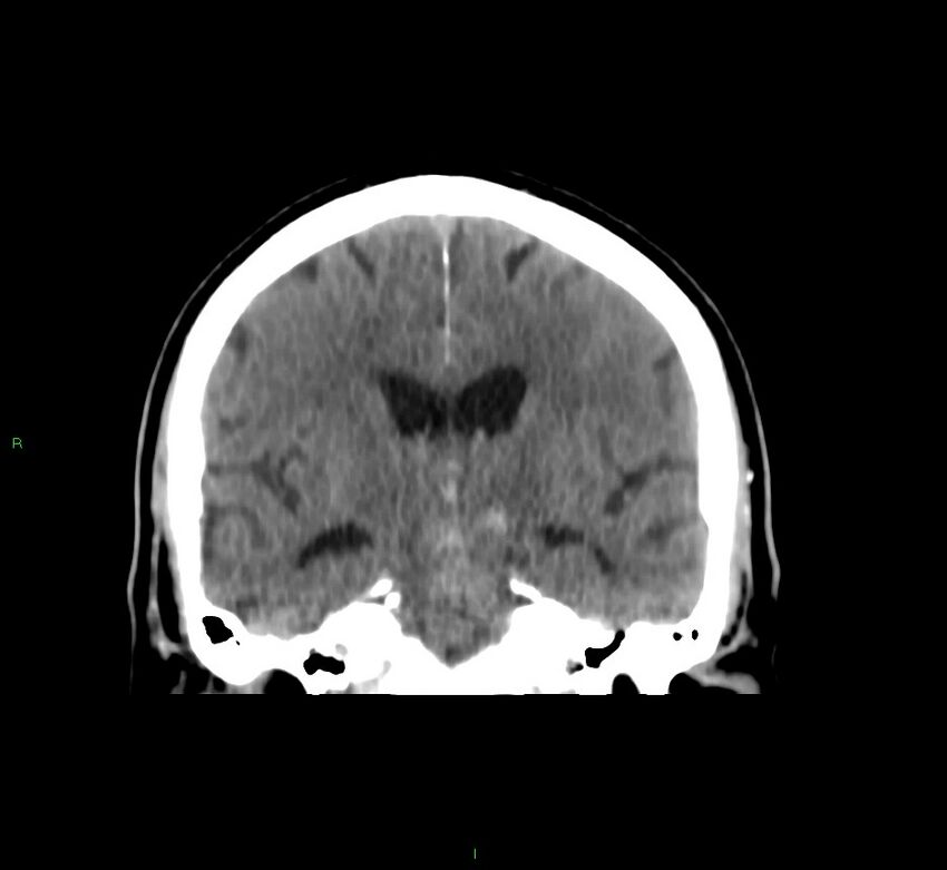 Brainstem hemorrhage (Radiopaedia 58794-66028 Coronal non-contrast 34).jpg