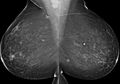 Breast cancer and multiple circumscribed masses (Radiopaedia 62456-70698 MLO 1).jpeg