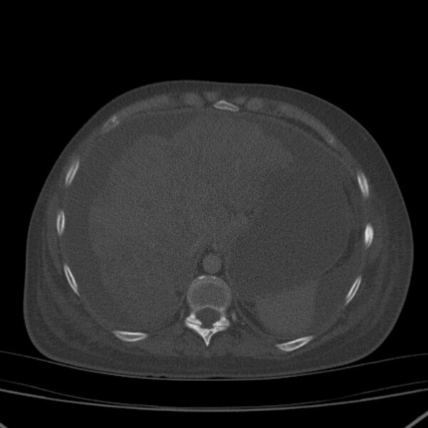 File:Breast cancer metastases - hepatic and skeletal (Radiopaedia 34201-35461 Axial bone window 36).jpg