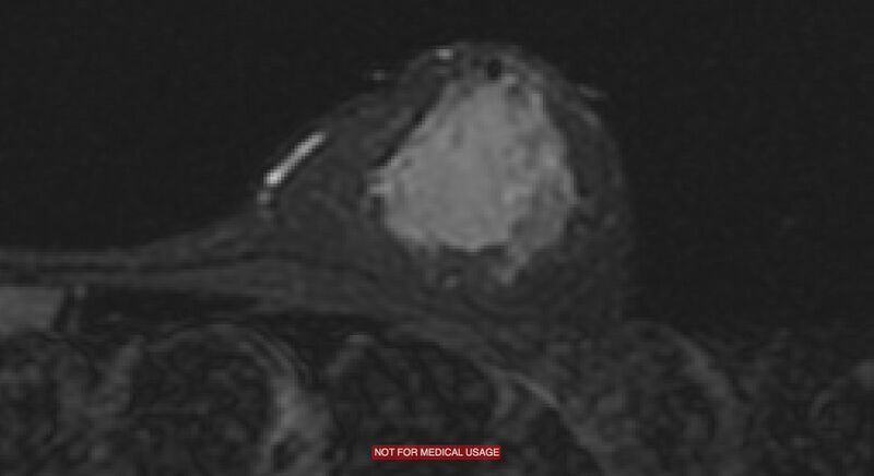 File:Breast lymphoma (MRI) (Radiopaedia 34999-36498 Axial STIR 4).jpg