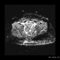 Broad ligament fibroid (Radiopaedia 49135-54241 Axial ADC 15).jpg