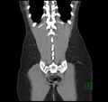 Broad ligament hernia (Radiopaedia 63260-71832 B 33).jpg