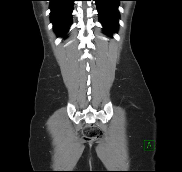 File:Broad ligament hernia (Radiopaedia 63260-71832 B 33).jpg