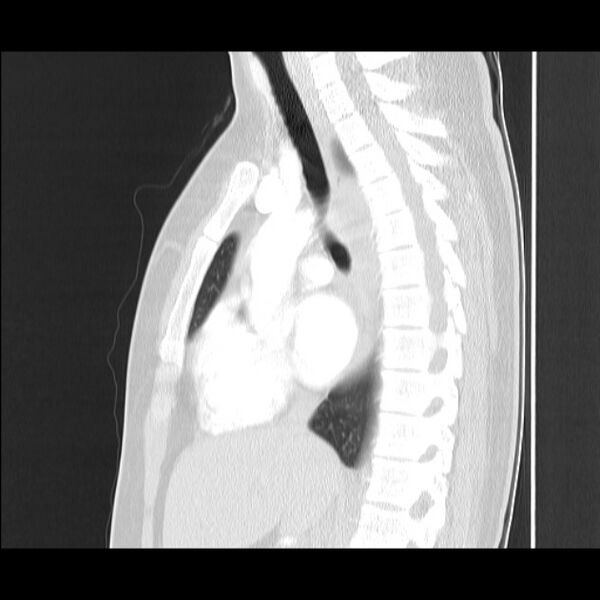 File:Bronchial atresia (Radiopaedia 22965-22992 Sagittal lung window 29).jpg