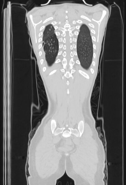 File:Bronchial carcinoid tumor (Radiopaedia 57187-64090 Coronal lung window 99).jpg