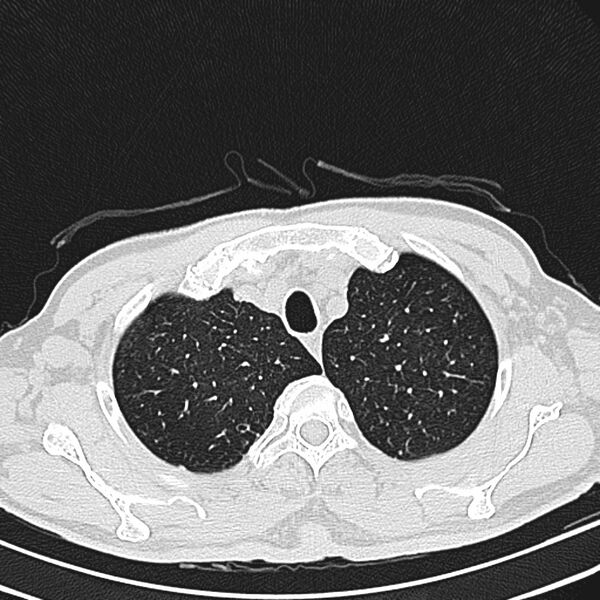 File:Bronchiectasis (Radiopaedia 22061-22059 lung window 5).jpg