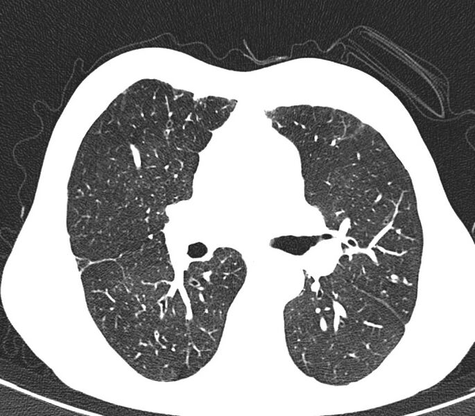 File:Bronchiolitis (Radiopaedia 24616-24887 Axial lung window 26).jpg
