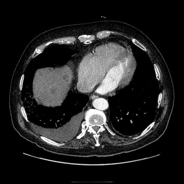 File:Bronchogenic adenocarcinoma and pulmonary embolism (Radiopaedia 9097-9806 D 44).jpg