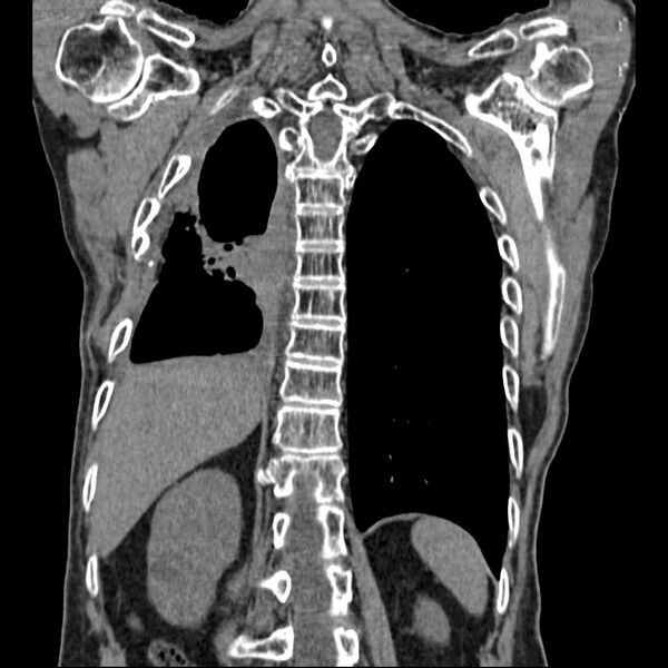 File:Bronchopleural fistula - postoperative complication (Radiopaedia 21020-20947 Coronal non-contrast 22).jpg