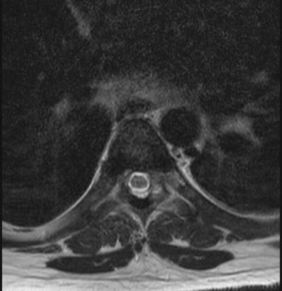 File:Brown tumors compressing the spinal cord (Radiopaedia 68442-78030 A 33).jpg