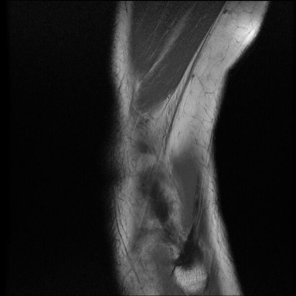 File:Bucket-handle meniscus tear (Radiopaedia 65700-74809 Sagittal T1 21).jpg