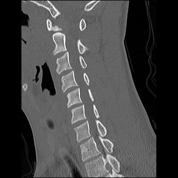 File:C5 facet fracture (Radiopaedia 58374-65499 Sagittal bone window 41).jpg