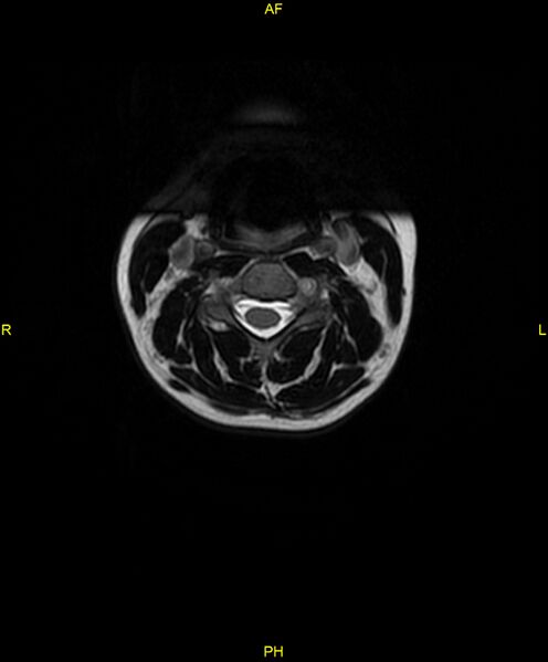 File:C5 nerve sheath tumor (Radiopaedia 85777-101596 Axial T2 18).jpg