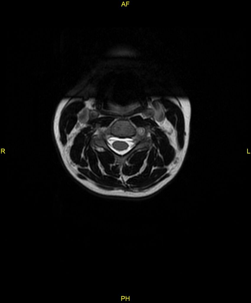 C5 nerve sheath tumor (Radiopaedia 85777-101596 Axial T2 18).jpg