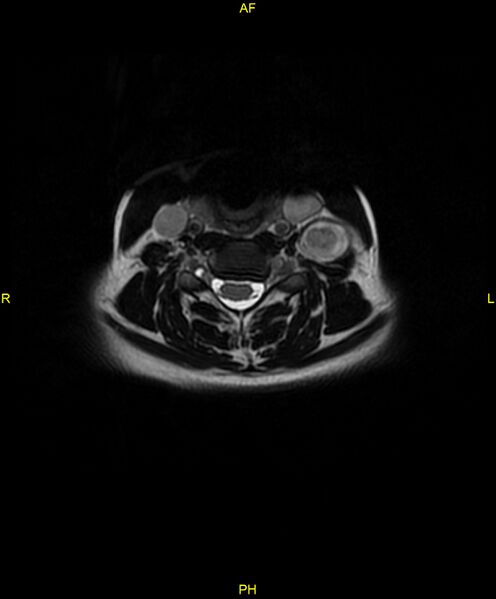 File:C5 nerve sheath tumor (Radiopaedia 85777-101596 Axial T2 39).jpg