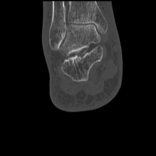 File:Calcaneal tuberosity avulsion fracture (Radiopaedia 22649-22668 Coronal bone window 52).jpg