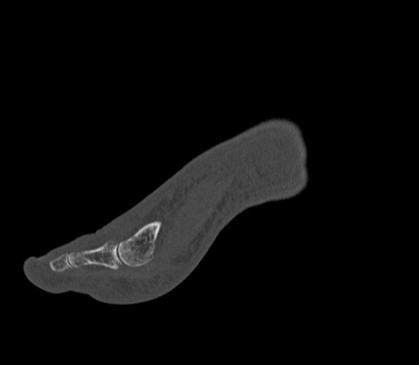 Calcaneal tuberosity avulsion fracture (Radiopaedia 22649-22668 Sagittal bone window 46).jpg