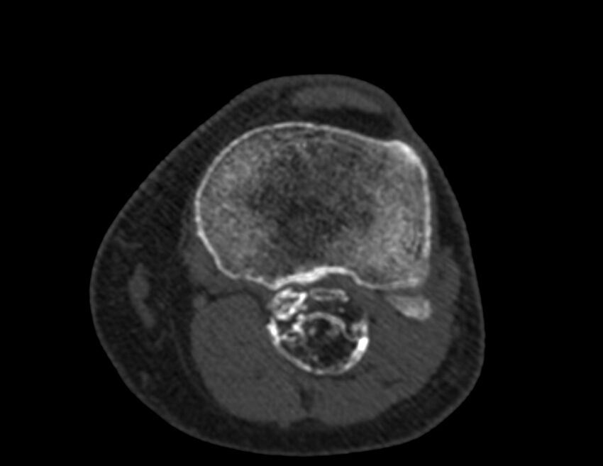 Calcified hematoma - popliteal fossa (Radiopaedia 63938-72763 Axial bone window 52).jpg
