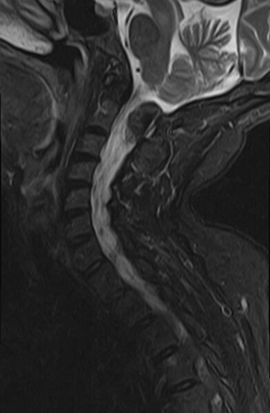 File:Calcified meningioma - cervical canal (Radiopaedia 70136-82468 Sagittal STIR 6).jpg
