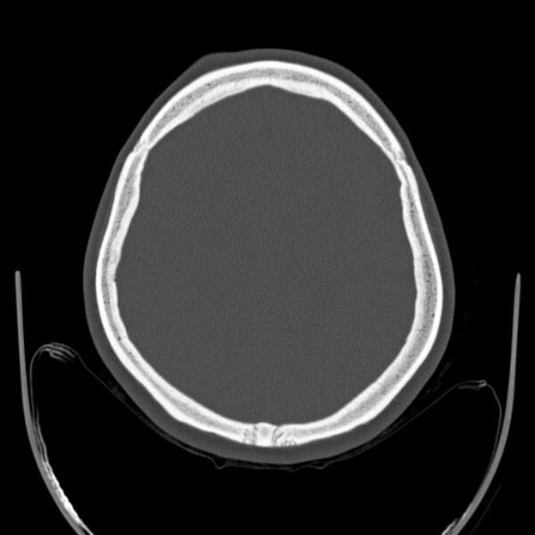 File:Calvarial osteoma (Radiopaedia 36520-38079 Axial bone window 78).jpg