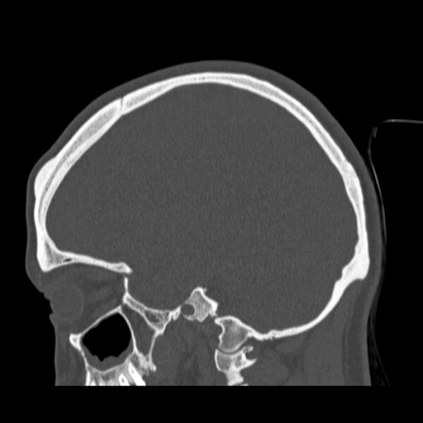 File:Calvarial osteoma (Radiopaedia 36520-38079 Sagittal bone window 41).jpg
