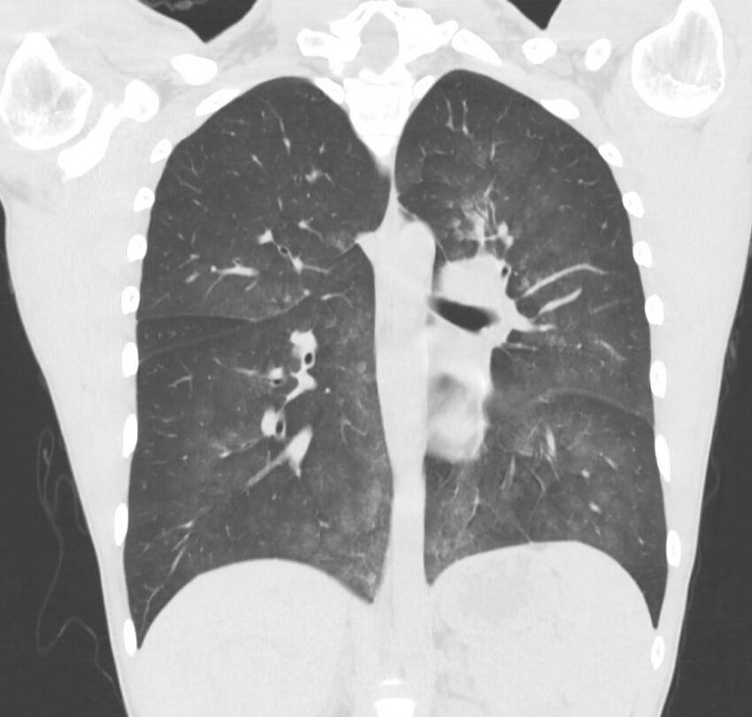 Cannabis-induced diffuse alveolar hemorrhage (Radiopaedia 89834-106946 Coronal lung window 38).jpg
