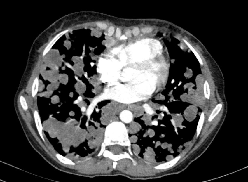 Cannonball metastases from breast cancer (Radiopaedia 91024-108569 A 73).jpg