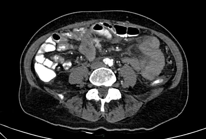 Carcinoid mesenteric tumor complicated by chylous ascites (Radiopaedia 76312-88926 A 43).jpg
