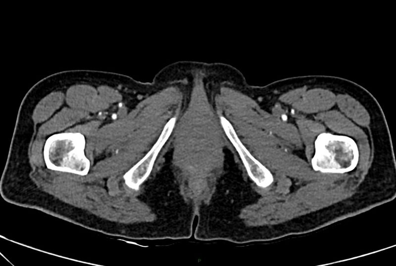 File:Carcinoid mesenteric tumor complicated by chylous ascites (Radiopaedia 76312-88926 A 85).jpg