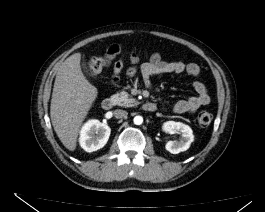 Carcinoid tumor with hepatic metastases (Radiopaedia 22651-22670 B 35).jpg