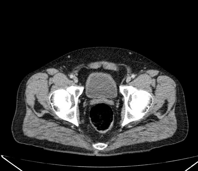 File:Carcinoid tumor with hepatic metastases (Radiopaedia 22651-22670 C 76).jpg
