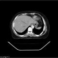 Carcinoma cervix- recurrence (Radiopaedia 34702-36137 B 8).jpg