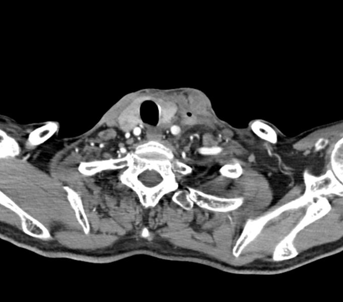 File:Carotid artery pseudoaneurysm (Radiopaedia 84030-99259 C 68).jpg