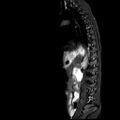 Caudal regression syndrome (Radiopaedia 61990-70072 Sagittal T2 TIRM 9).jpg