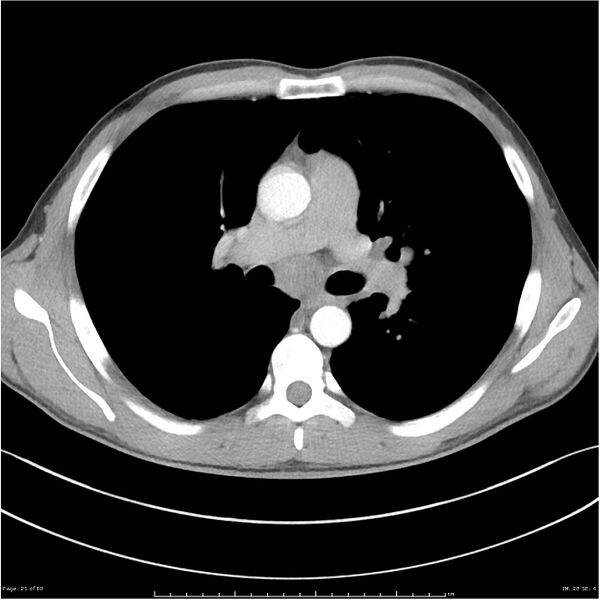 File:Cavitating lung cancer (Radiopaedia 25796-25945 C+ arterial phase 25).jpg