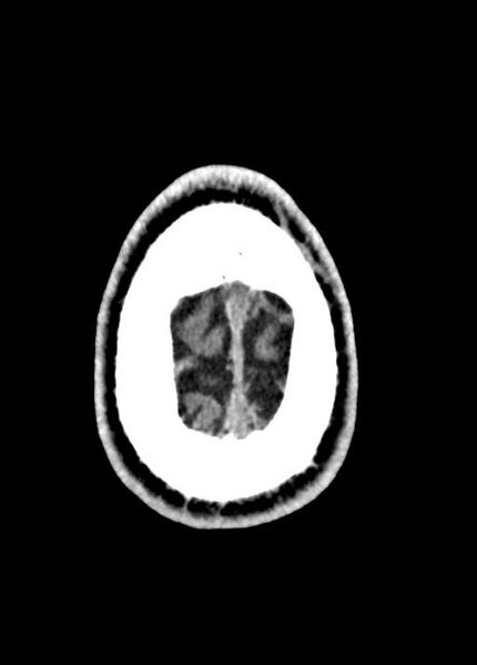 File:Cavum septum pellucidum and cavum vergae (Radiopaedia 77797-90060 Axial Brain Window 99).jpg