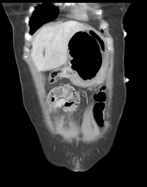 File:Cecum hernia through the foramen of Winslow (Radiopaedia 46634-51112 B 11).png