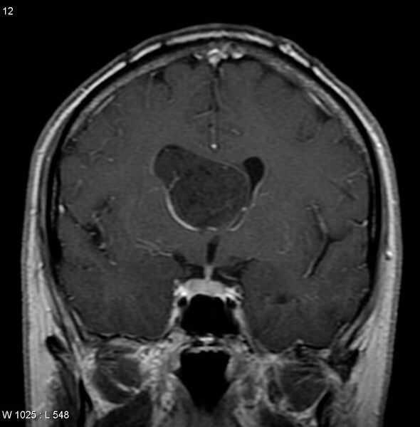 File:Central neurocytoma (Radiopaedia 4956-6850 Coronal T1 C+ 1).jpg