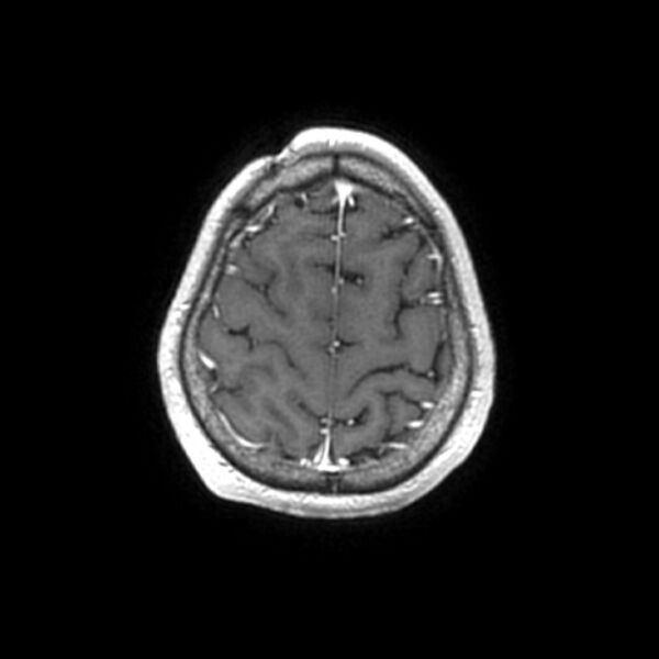 File:Central neurocytoma (Radiopaedia 67618-77021 Axial T1 C+ 26).jpg