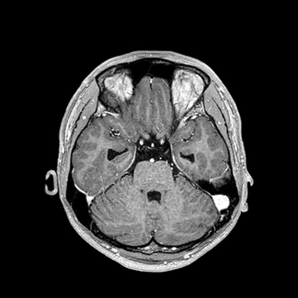 File:Central neurocytoma (Radiopaedia 79320-92380 Axial T1 C+ 90).jpg